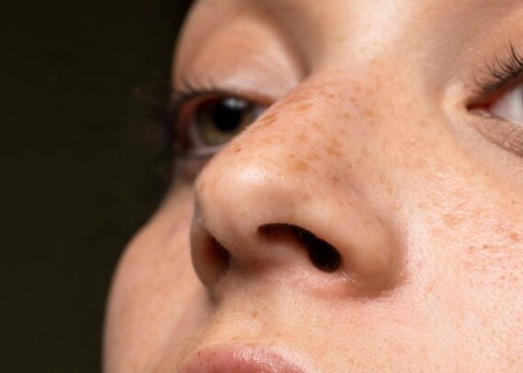 Mengatasi flek hitam bisa dilakukan dengan cara alami. Foto: Freepik