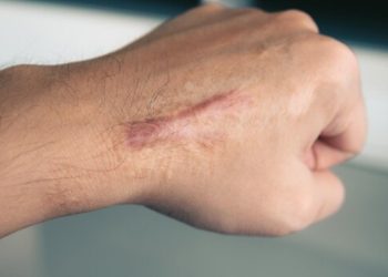 Bekas Luka Hilang Lebih Cepat! Ini 7 Bahan Alami yang Harus Kamu Gunakan