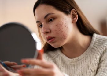Jerawat di Wajah? Kenali Tanda-Tanda Masalah Kesehatan yang Tersembunyi