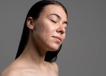 5 Kesalahan Perawatan Kulit yang Membuat Jerawatmu Tak Kunjung Hilang